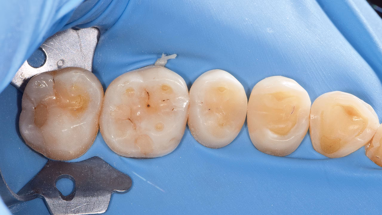 Was ist eine Kavität im Kieferknochen?