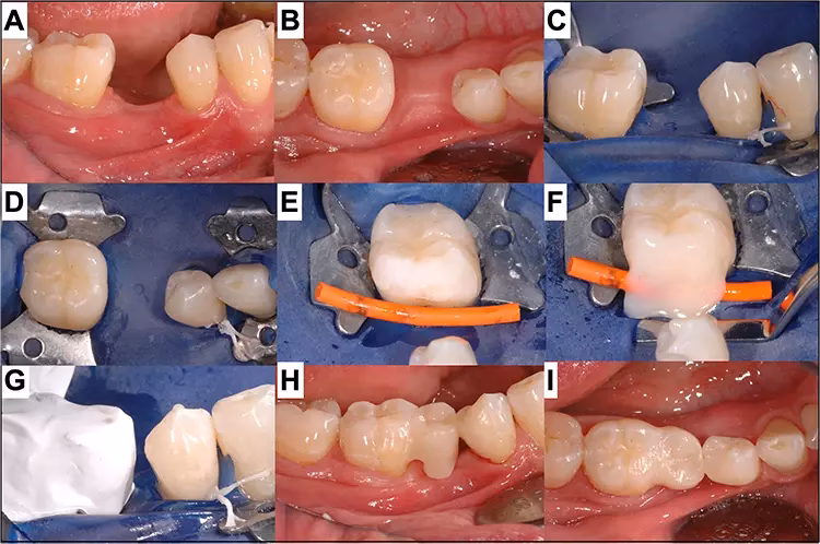 Was kostet das Präparieren einer Kavität und Restauration mit Kompositmaterialien?