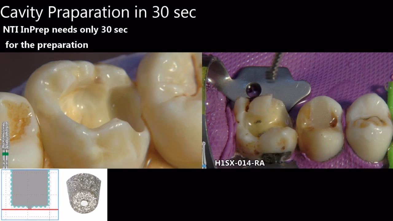 Wie wird die Adhäsivtechnik konditioniert?